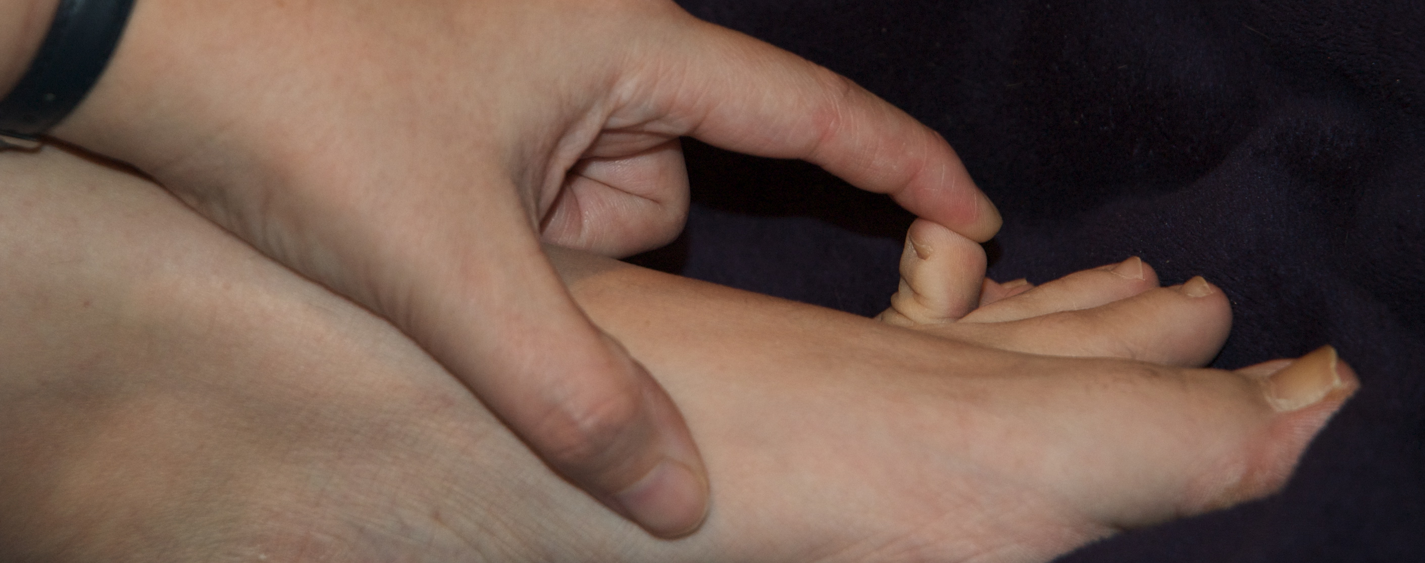 Syndrome d’Ehlers-Danlos - Dorsiflexion de l'orteil