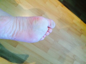 Raynaud pied