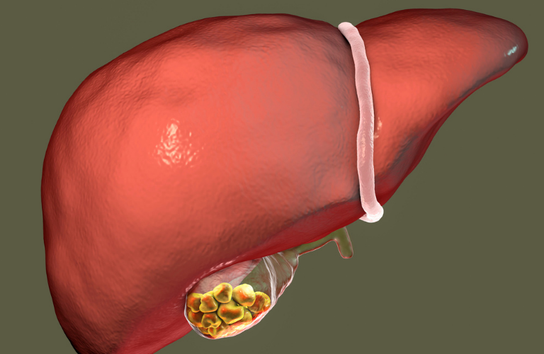 Calculs biliaires