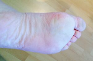 Gros plan sur la plante de mon pied gauche, avec une zone blanche.