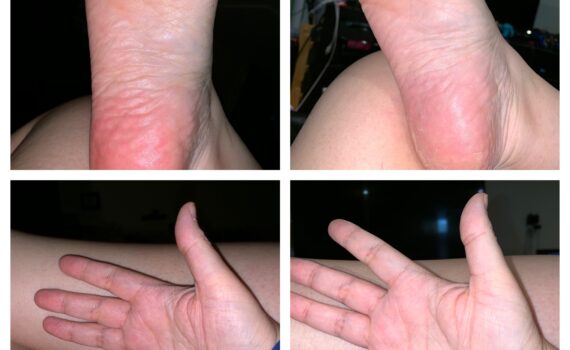 4 cadrans, les 2 du haut sont le dessous de mon pied droit, très rouge à gauche. Les 2 du bas sont la paume de ma main droite, très rouge à gauche.