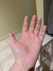 La même main, gauche et paume vers le haut, très rouge. On note de l'enflure par les lignes de la paume moins visibles.